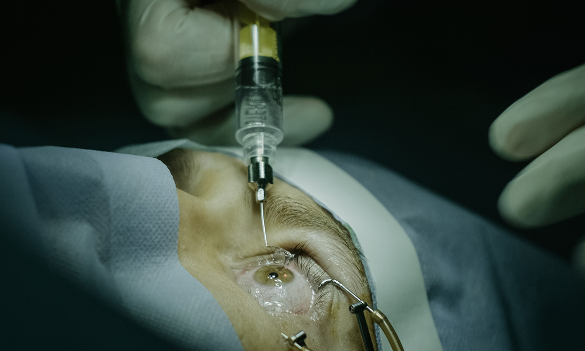 FDA genehmigt Vabysmo® zur Behandlung des retinalen Venenverschlusses