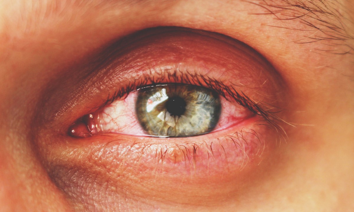 Warnzeichen: Wann rote Augen bedrohlich sind