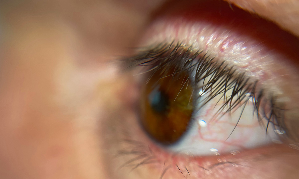 Auge aus dem Drucker: Erster Patient erhält vollständig digital gedruckte 3D-Augenprothese