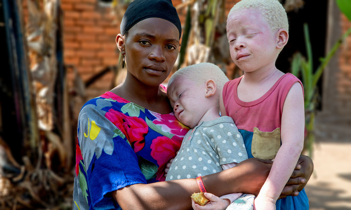 Welt-Albinismus-Tag – CBM fordert mehr Aufklärung