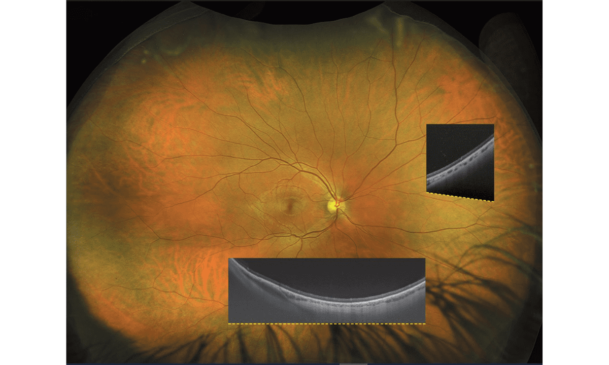 30 Jahre Optos®: UWF-Bildgebung revolutioniert Retina-Diagnostik