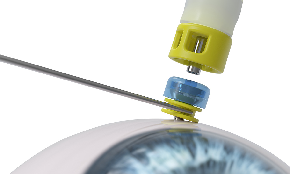 DORC launches EVA NEXUS – uniting inspiration and innovation to deliver the future of ophthalmic surgery