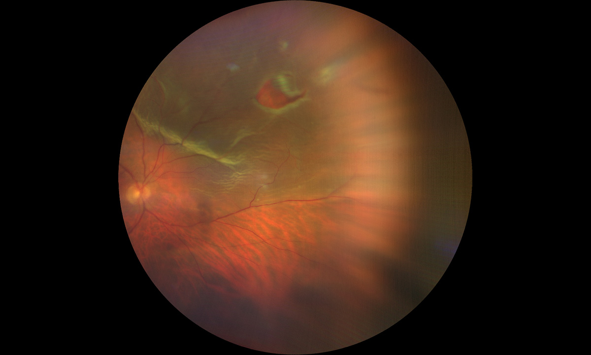 Stiftung Auge: Vorsicht bei Netzhautablösung