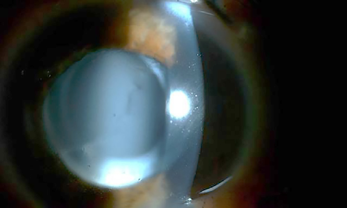 Spaltlampenbild des linken Auges
