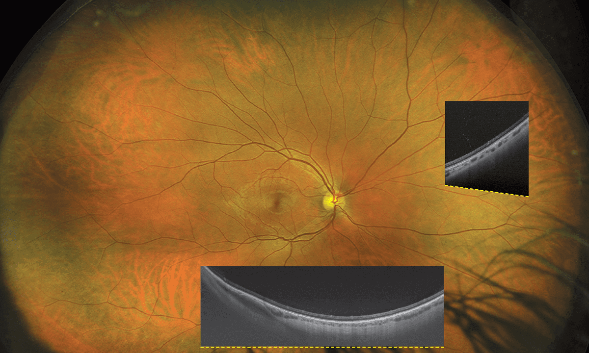 optomap®: effiziente Detektion von kritischen Veränderungen in weniger als einer halben Sekunde – mit 200°-Retina-Bildgebung