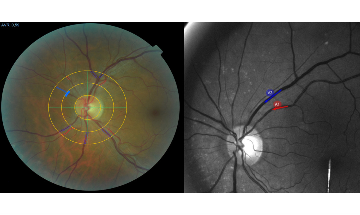 Blutgefäße im Auge verändert: Neuer Ansatz für Test auf Long Covid