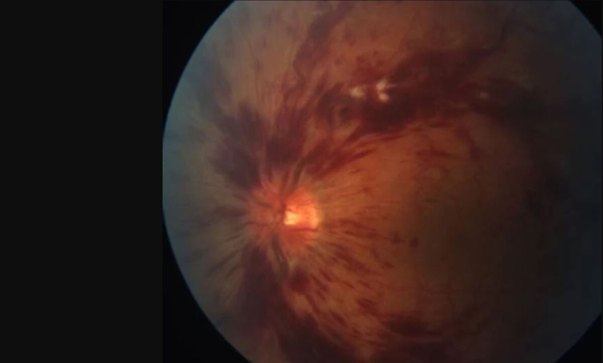 Flammenförmige Blutungen im Auge – Was steckt dahinter?