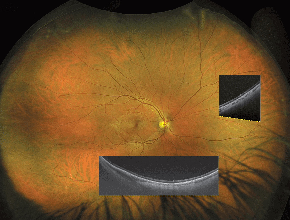 optomap®: effiziente Detektion von kritischen Veränderungen in weniger als einer halben Sekunde – mit 200°-Retina-Bildgebung