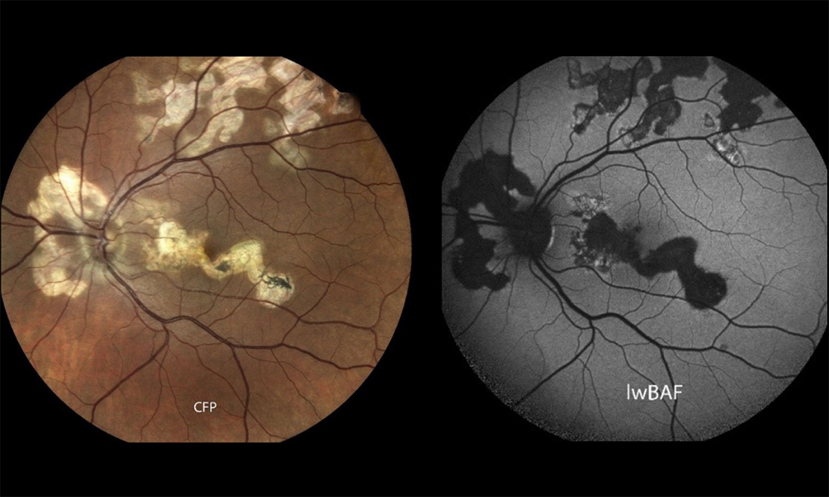 Die Augenhintergrund-Fotografie (l) zeigt Narbenareale in einem hellen Gelbton. Aktive entzündliche Läsionen zeigen sich in der FAF (r) meist als helle Bereiche. Bild: UKB