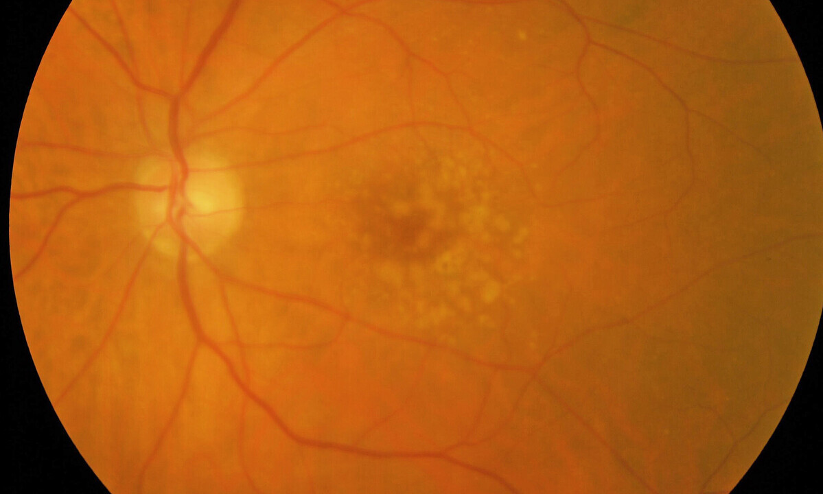 Formation of Drusen: NIH Study Reveals Cellular Pathology of Dry AMD