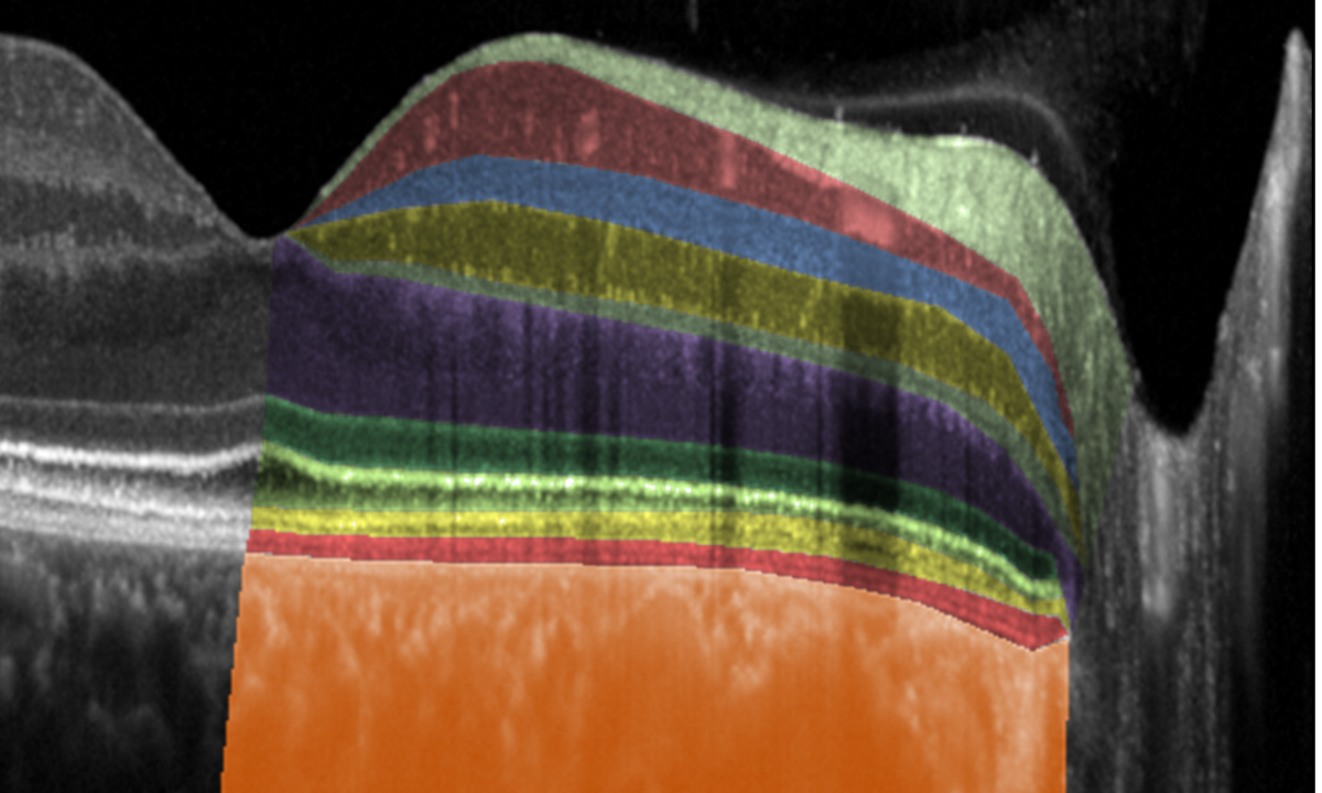 High-resolution OCT Schnitt durch die Fovea (Ausschnitt). Bild: Universitätsklinikum Bonn