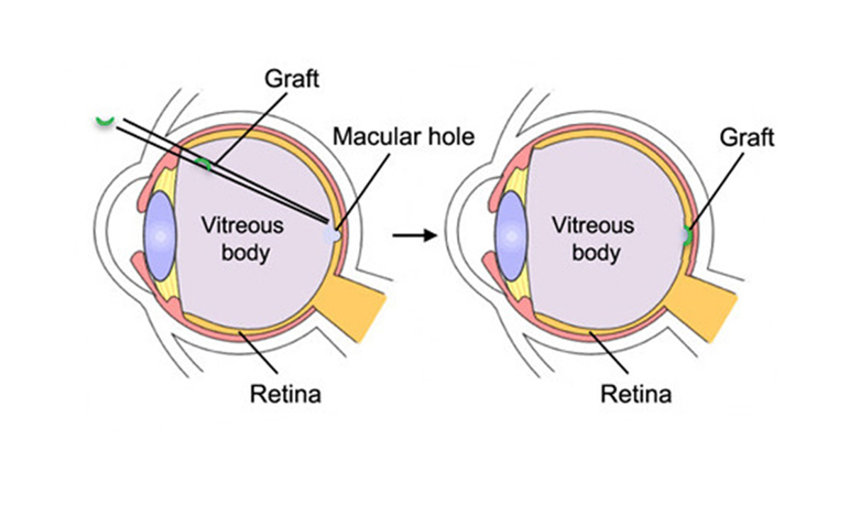 Stem Cells Repair Retinas in Monkey Models of Macular Holes