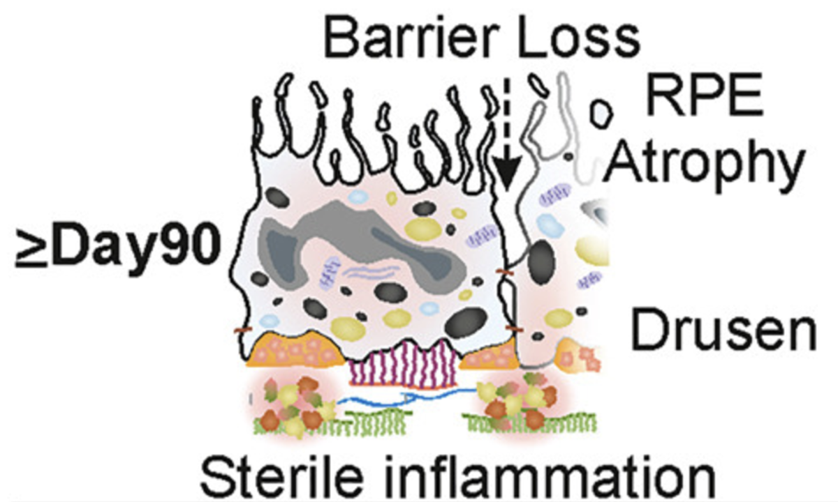 AMD and Related Macular Dystrophies: Discovery of Novel Therapeutic Targets