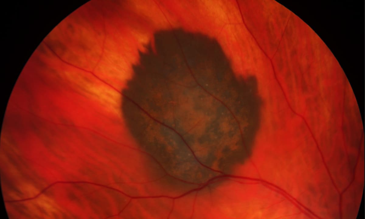 Das Aderhautmelanom zeichnet sich dunkel gegen das gesunde Gewebe des Augenhintergrundes ab. Bild: Universitätsklinikum Heidelberg