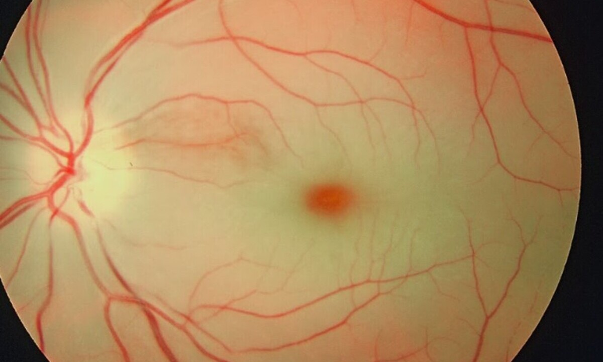 Novel Protocol to Rapidly Diagnose and Treat Central Retinal Artery Occlusion