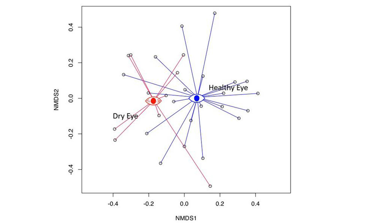 Streptococcus and Pedobacter were most prevalent in healthy eyes (blue) while more Acinetobacter were present in the eye microbiome of people with dry eye (red). Image: Pallavi Sharma, Stephen F. Austin State University