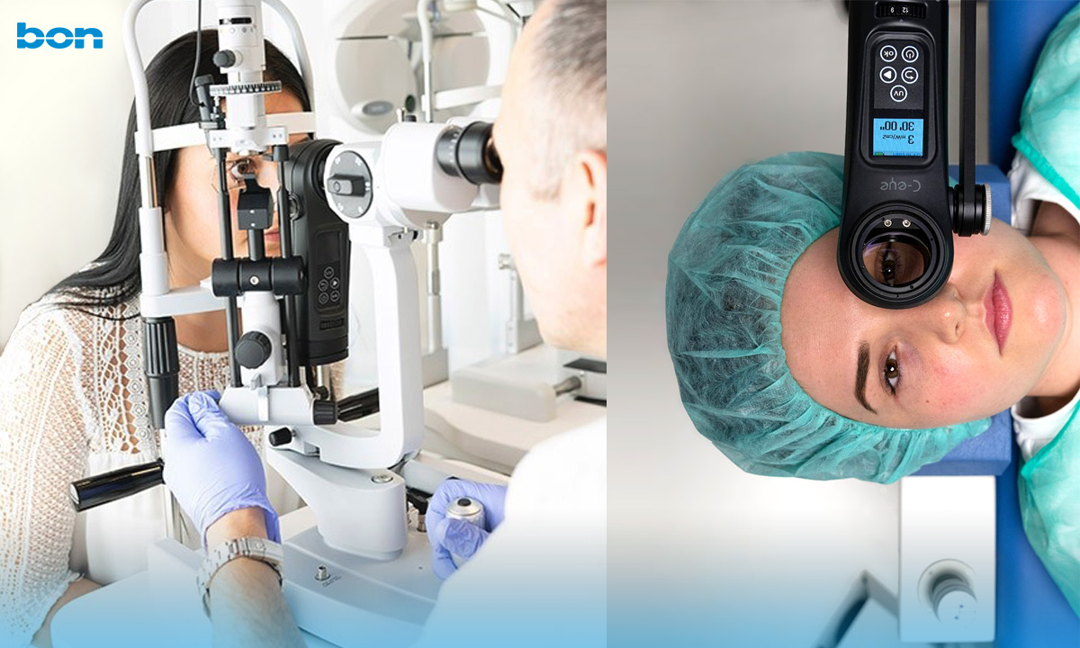 Corneales Crosslinking an der Spaltlampe oder im OP?