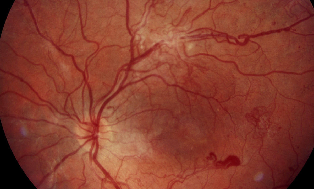 Blick ins Auge: Netzhaut-Scans als Schlüssel zur Früherkennung von Diabetes, Bluthochdruck und Alzheimer?