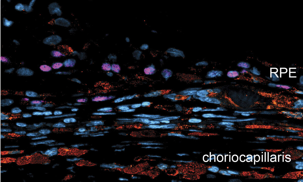 US scientists test surgical technique to improve cell therapy for dry AMD