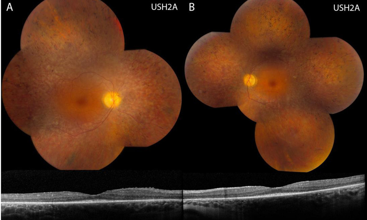 Neuer Review zu syndromaler Retinitis pigmentosa