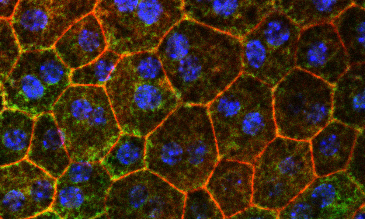 Cholesterol Processing: Strategy to prevent age-related macular degeneration identified