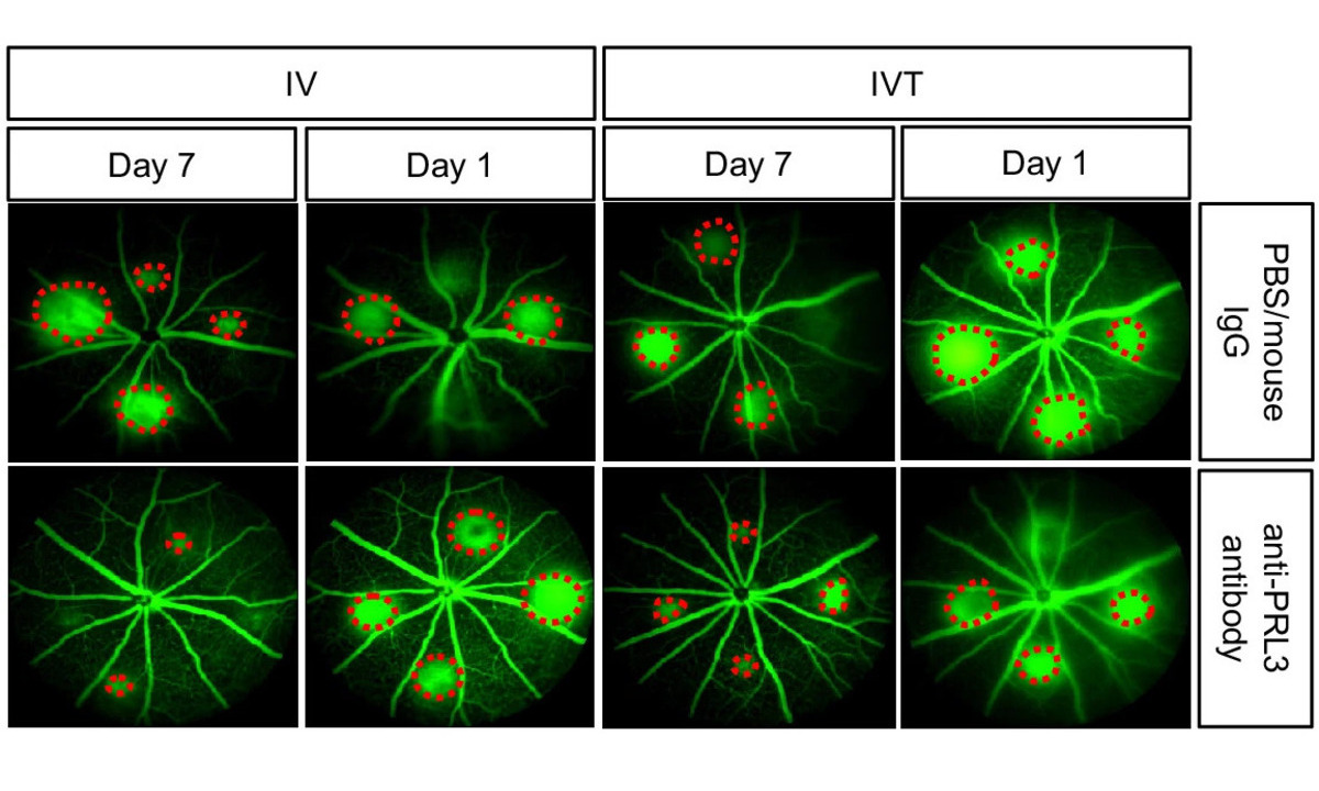 Cancer Drug Shows Promise as Novel Treatment for Neovascular Eye Diseases