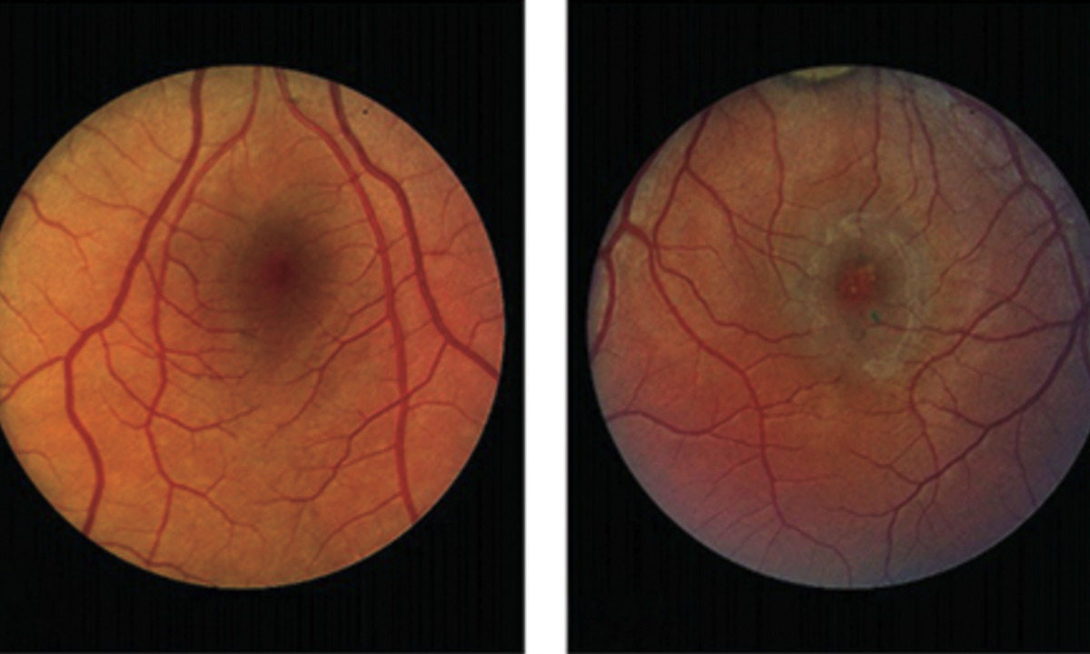 MacTel: Study confirms long-term benefit of neuroprotective implant