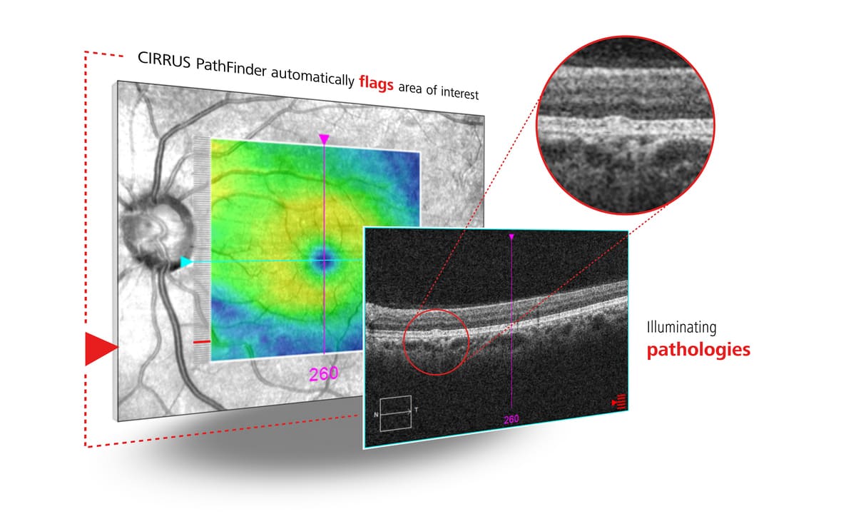 ZEISS erhält CE-Kennzeichnung für CIRRUS PathFinder für KI-unterstützte OCT-Auswertung