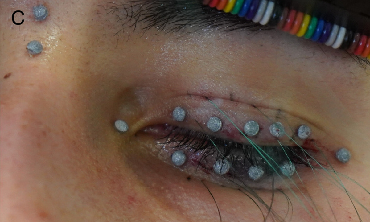 Neues zur Biomechanik der Augenlider