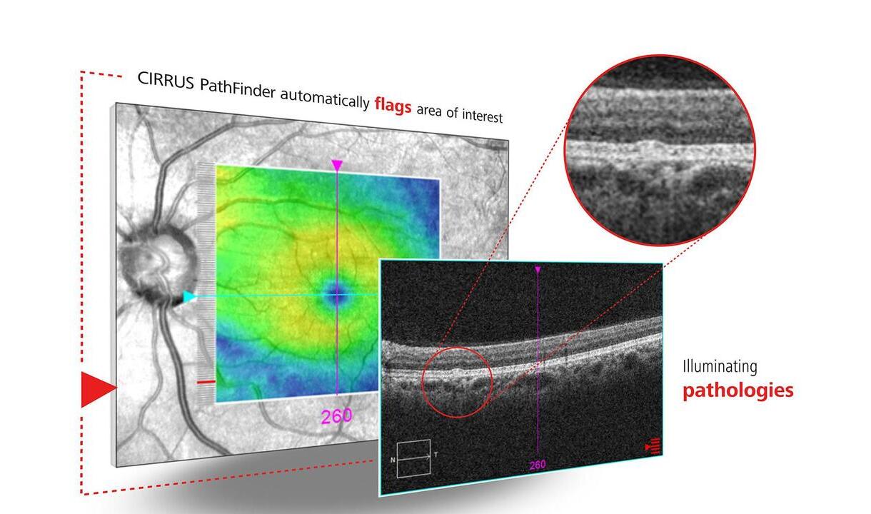 ZEISS präsentiert branchenführende Workflow-Lösungen und neue Meilensteine für die Refraktiv- und Kataraktchirurgie