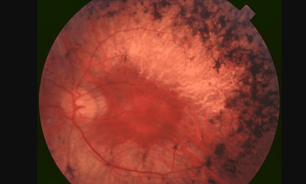 Mitmachen für die Zukunft der RP-Therapie!  Studienaufruf der Universitäts-Augenklinik Bonn