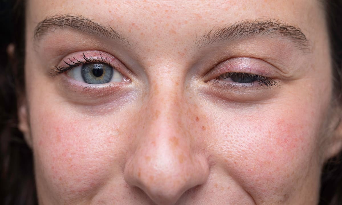 Myasthenia Gravis: Cochrane Review on Benefits and Harms of Immunoglobulin