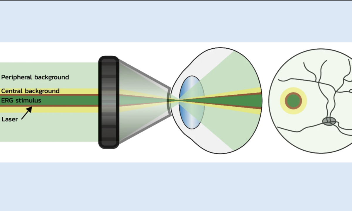 AMD: New laser treatment the first to halt disease’s progression?