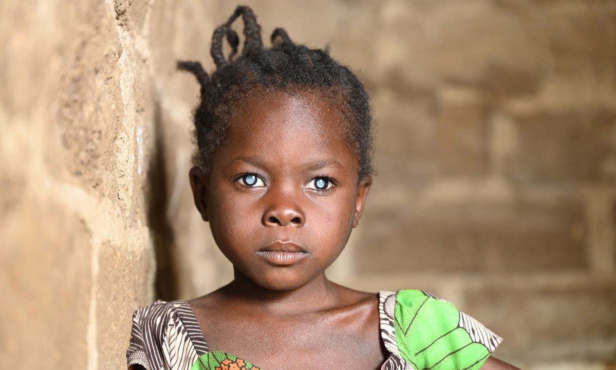 Einfache Operation, großes Wunder: Christoffel-Blindenmission schenkt Kindern Augenlicht