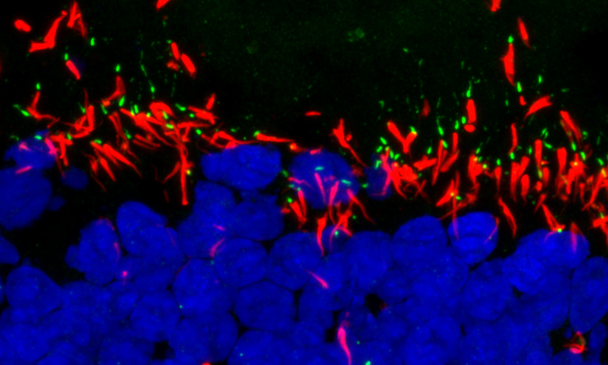 World-first use of stem cells to study a form of genetic blindness
