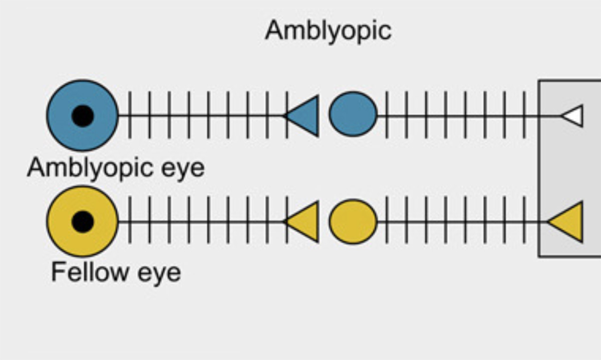 MIT study shows how vision can be rebooted in adults with amblyopia