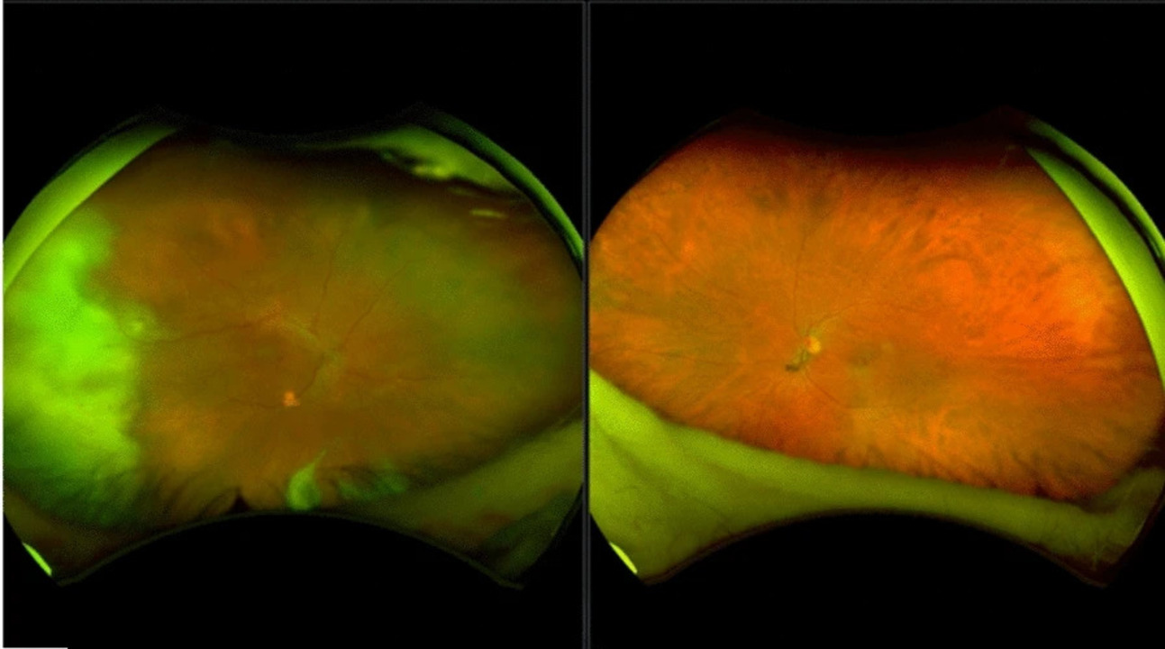 New international guidelines redefine diagnosis and treatment of fungal eye infections