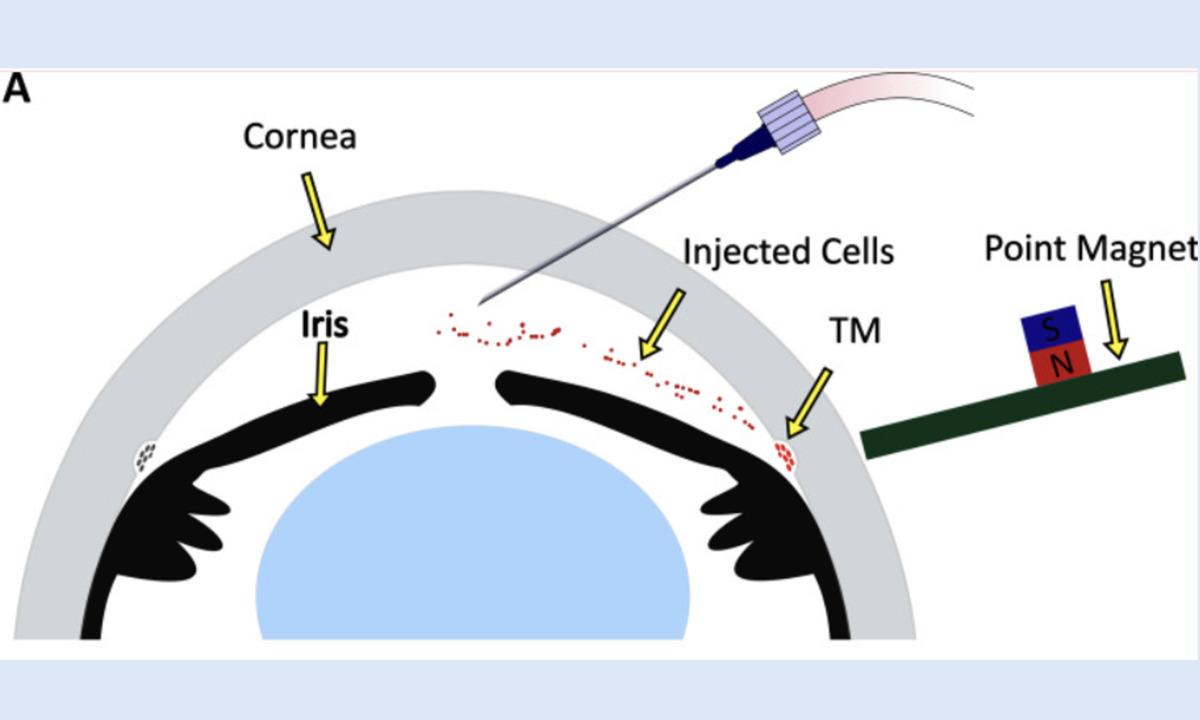 Stammzelltherapie: Neuer Ansatz zur IOD-Senkung bei Glaukom