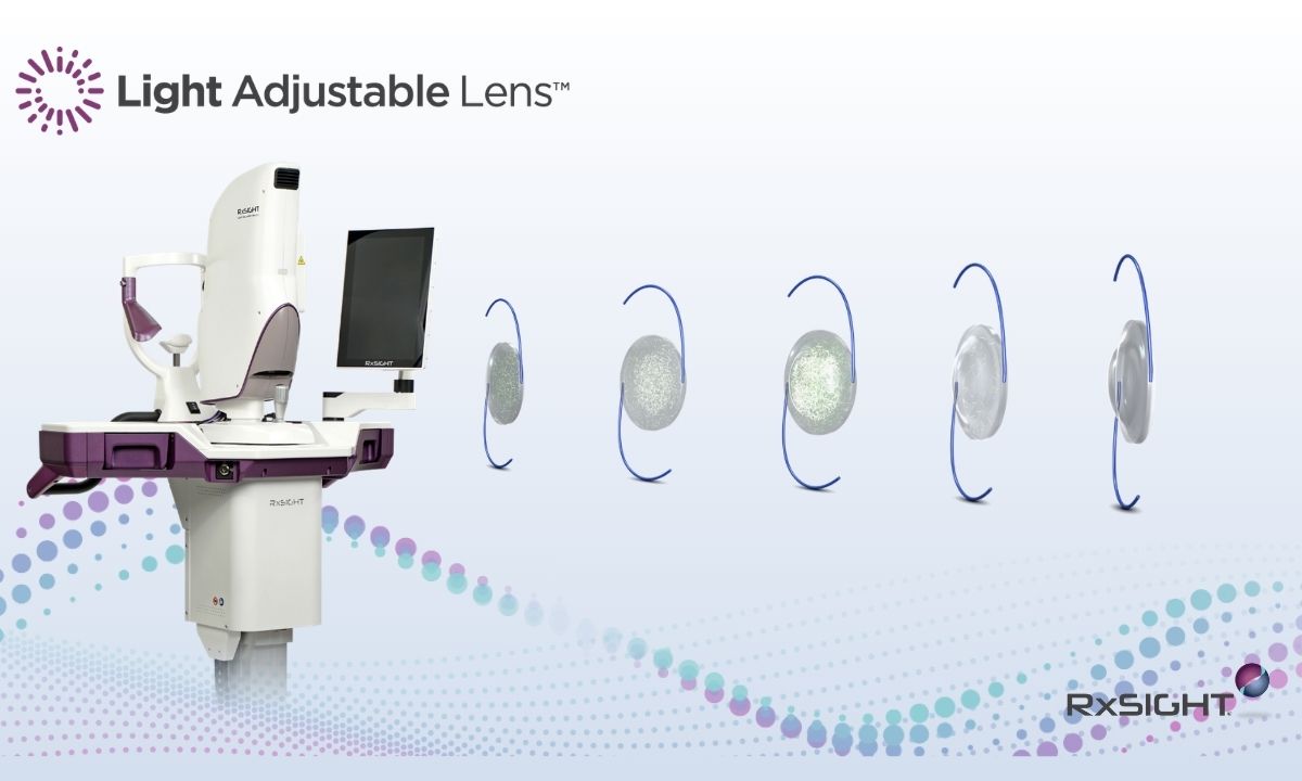 Verbesserung der refraktiven Ergebnisse mit der RxSight Light Adjustable Lens®