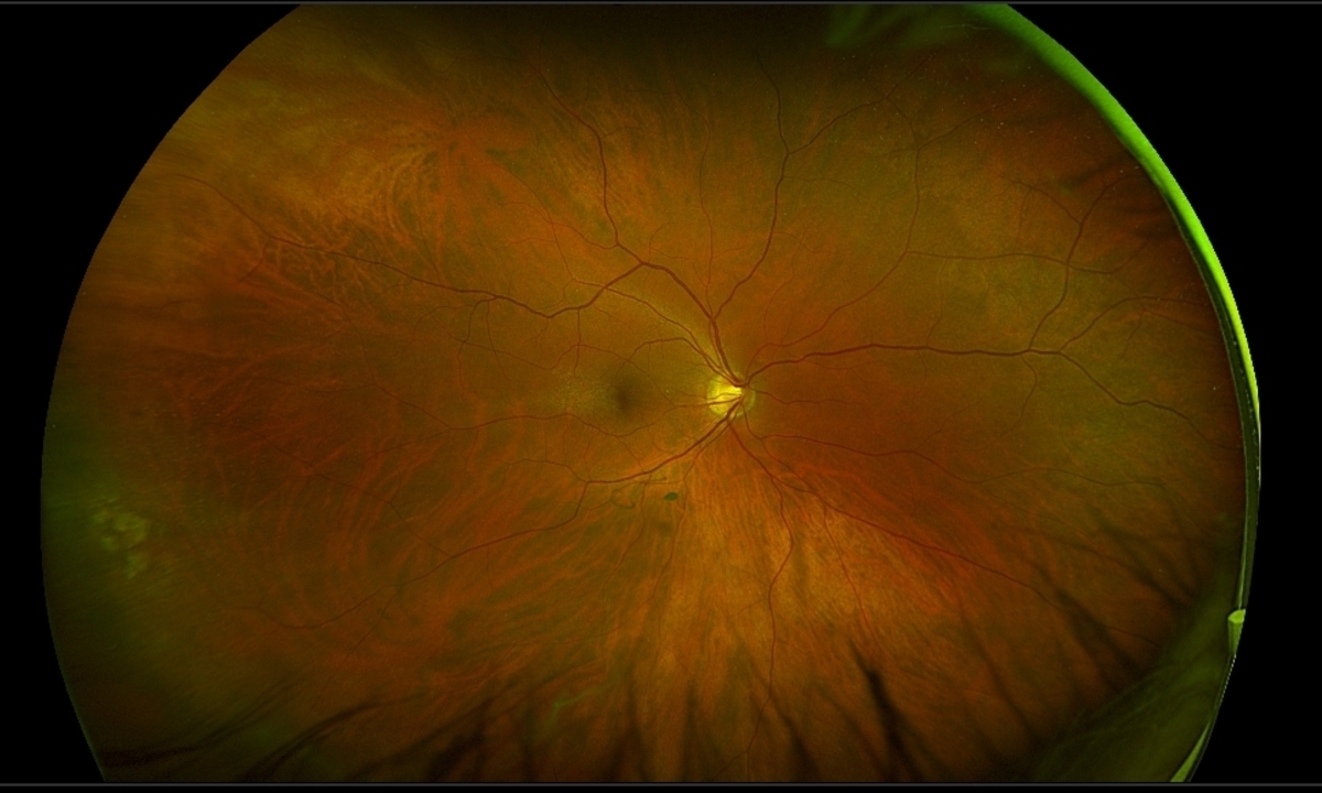 Retinal photographs can help predict Alzheimer’s disease risk factors