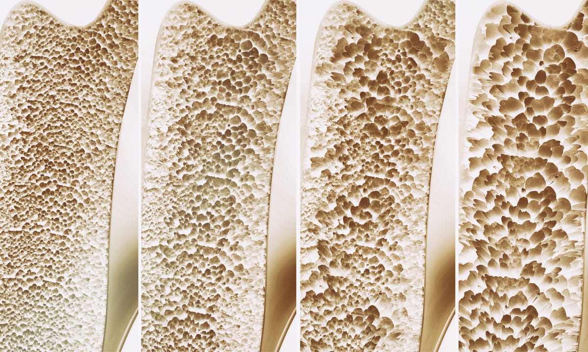 Biologisches Netzhautalter sagt Osteoporoserisiko voraus