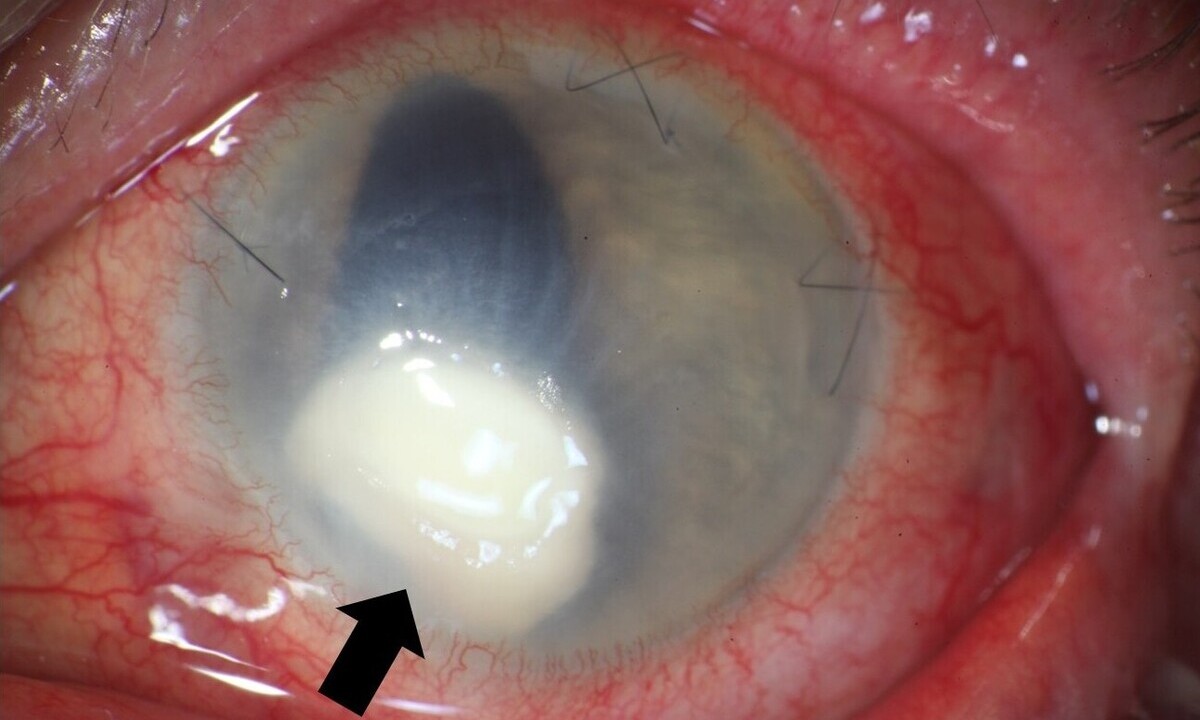 Pilzkeratitis: Neues Forschungsprojekt der Universitätsmedizin Würzburg