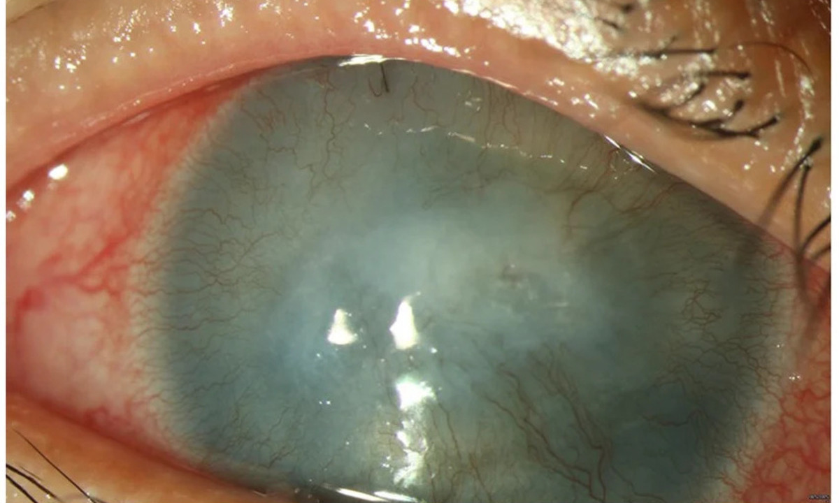 Aniridia-Related Keratopathy: New Stem Cell Treatment Improves Vision