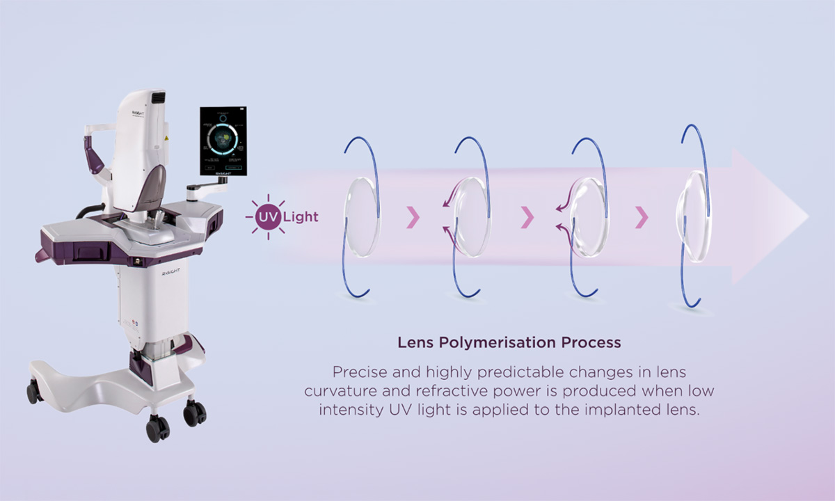 Die Light Adjustable Lens™ (LAL®) gewinnt auf der ESCRS 2026 weiter an Bedeutung