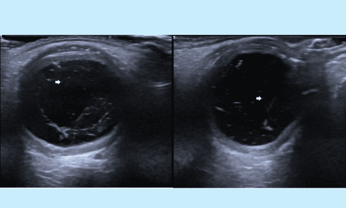 Chronic ocular hypotony: Moorfields Eye Hospital trials new treatment approach