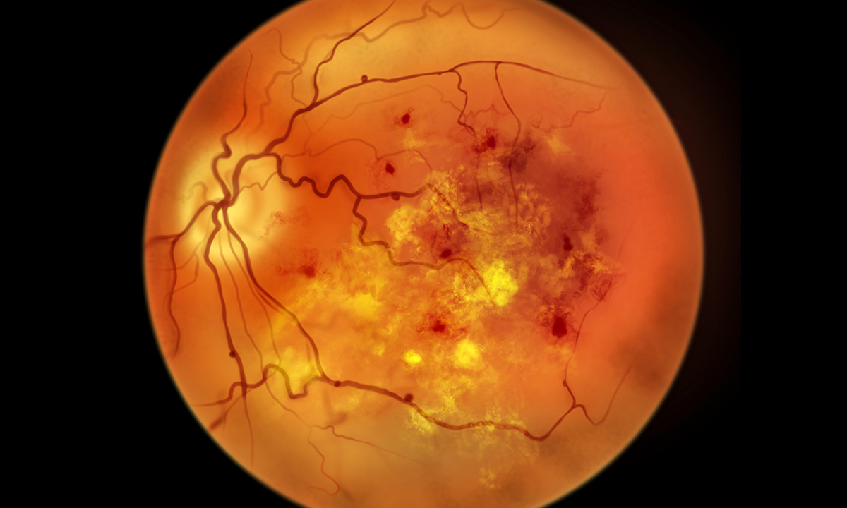 Zusammenhänge zwischen Darmfunktionsstörungen und Augen: Neue Behandlungsstrategien für diabetische Retinopathie