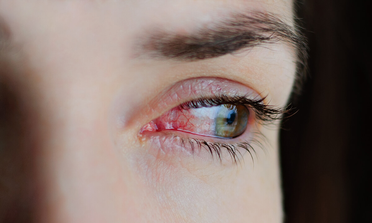 Rotes Auge – ein Symptom, viele Ursachen